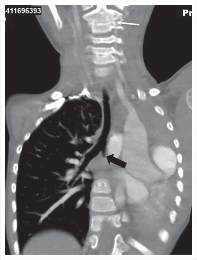 Unilateral opaque chest radiograph in paediatrics: A case series.