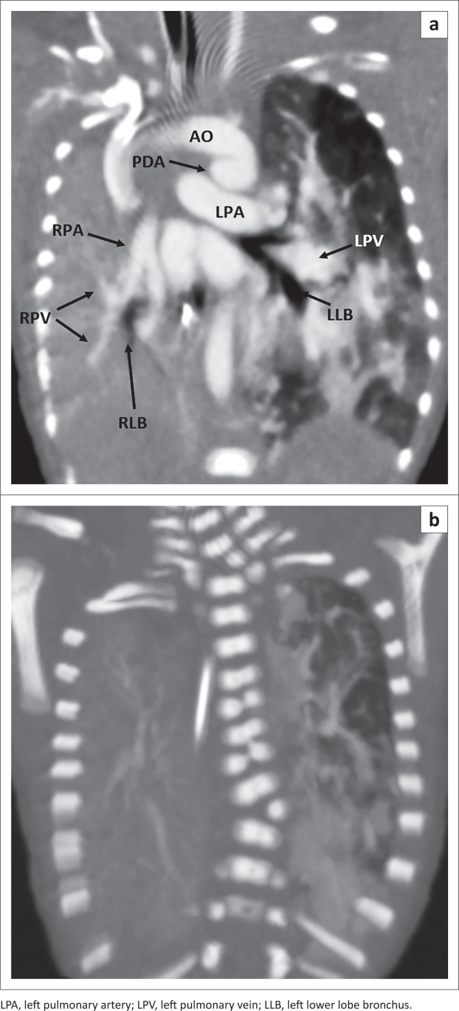 Unilateral opaque chest radiograph in paediatrics: A case series.