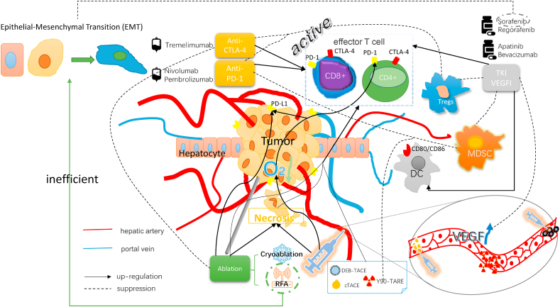 Advances in locoregional therapy for hepatocellular carcinoma combined with immunotherapy and targeted therapy