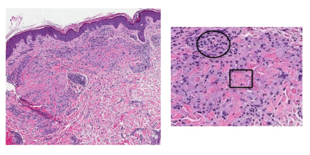 Management of a Unique Presentation of a Common Dermatologic Condition.