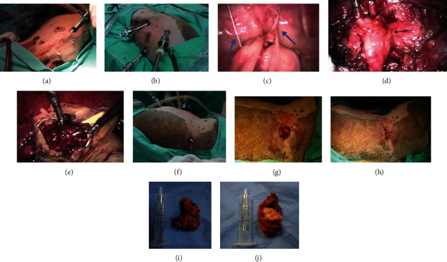 Laparoscopic Diagnosis and Treatment of Gossypiboma Postconventional Ovariohysterectomy in a Bitch.