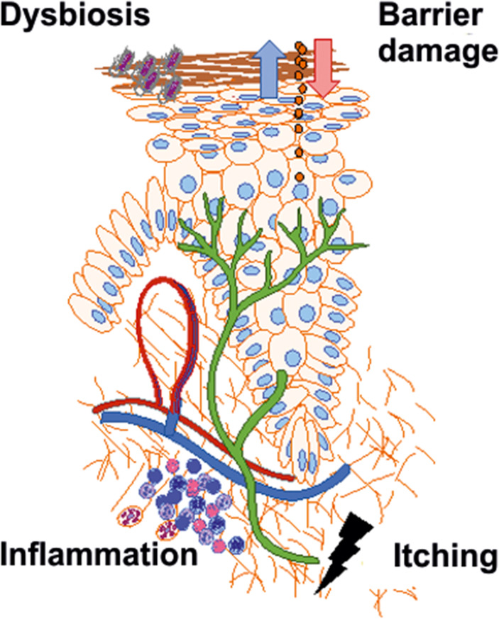 Anti-inflammatory topical medication - new developments in the treatment of atopic dermatitis.