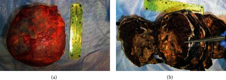 A Rare Presentation of Lisegang Rings in Adrenal Cavernous Hemangioma : Case Report and Literature Review.