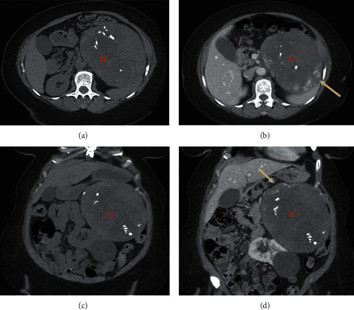 A Rare Presentation of Lisegang Rings in Adrenal Cavernous Hemangioma : Case Report and Literature Review.