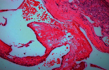 A Rare Presentation of Lisegang Rings in Adrenal Cavernous Hemangioma : Case Report and Literature Review.