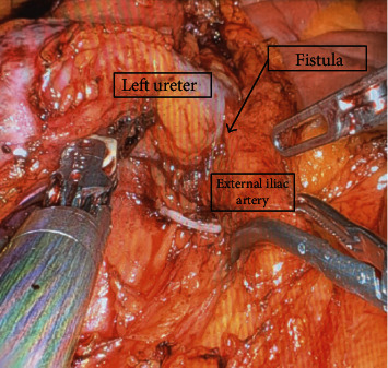 Ureteroarterial Fistula: A Diagnosis Which Is Not Always Black and White.