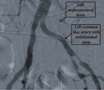 Ureteroarterial Fistula: A Diagnosis Which Is Not Always Black and White.