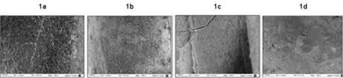 Efficacy of different instruments for the mechanical removal of the smear layer in immediate post preparations: a comparative study.