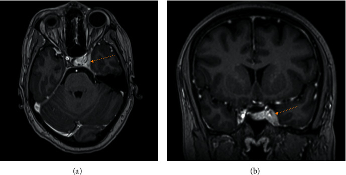 Recurrent Hodgkin's Disease Presenting as a Clinically Isolated Cavernous Sinus Syndrome.