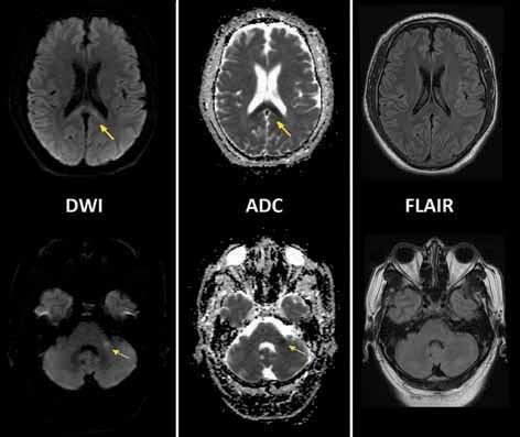 Cytotoxic Lesion in the Splenium of Corpus Callosum Secondary to Subacute Methotrexate Neurotoxicity.