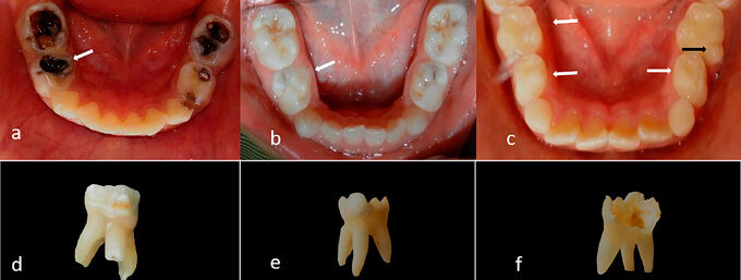 Prevalence of three-rooted primary mandibular first and second molars: clinical and radiographic findings in a Mexican population.