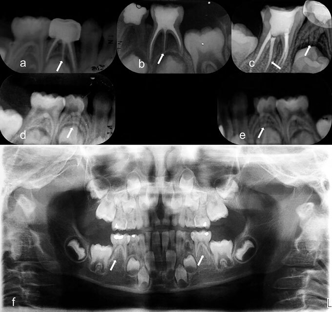 Prevalence of three-rooted primary mandibular first and second molars: clinical and radiographic findings in a Mexican population.