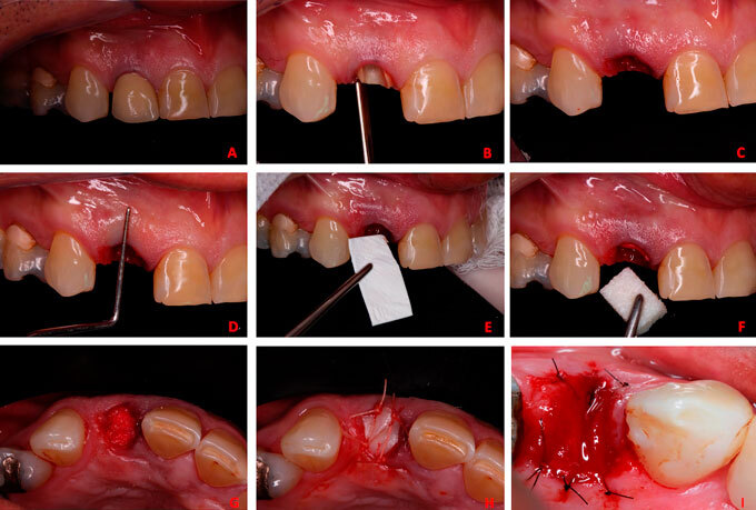 Impact of soft tissue graft on the preservation of compromised sockets: a randomized controlled clinical pilot study.