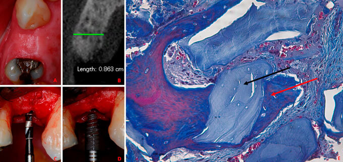 Impact of soft tissue graft on the preservation of compromised sockets: a randomized controlled clinical pilot study.