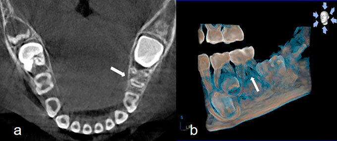 Prevalence of three-rooted primary mandibular first and second molars: clinical and radiographic findings in a Mexican population.