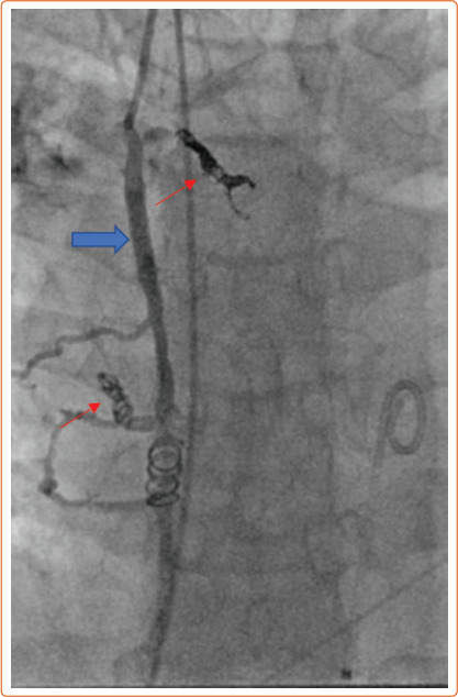 Unknown Risks of Transplantation in Adults with Congenital Heart Disease.