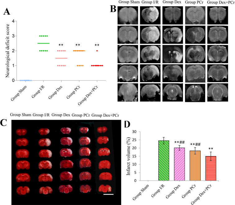 Dexmedetomidine and Phosphocreatine Post-treatment Provides Protection against Focal Cerebral Ischemia-reperfusion Injury in Rats.