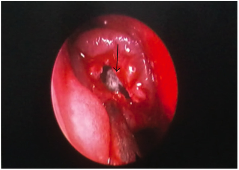 Unusual Location of a Fungus Ball: The Concha Bullosa, a Review of the Literature.