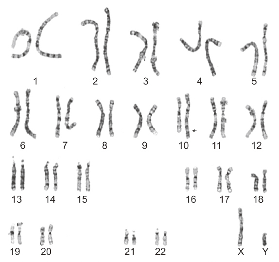 Perinatal diagnosis of a fetus with an unbalanced translocation 46,XY,der(10)t(6;10)(p22;q26.1) with multiple malformations:a case report and literature review.