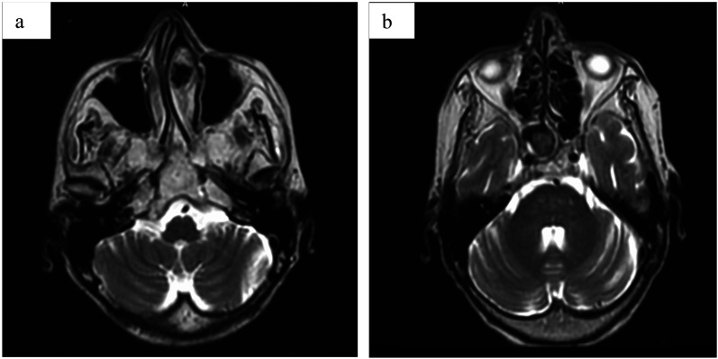 Unusual Location of a Fungus Ball: The Concha Bullosa, a Review of the Literature.