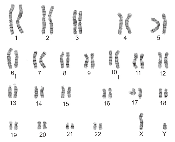 Perinatal diagnosis of a fetus with an unbalanced translocation 46,XY,der(10)t(6;10)(p22;q26.1) with multiple malformations:a case report and literature review.