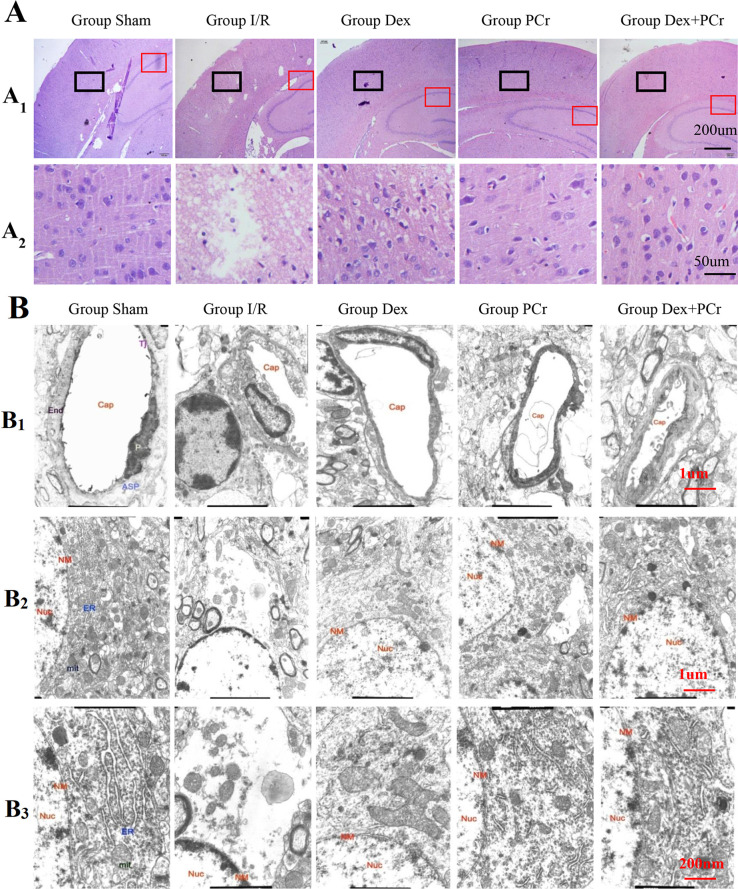 Dexmedetomidine and Phosphocreatine Post-treatment Provides Protection against Focal Cerebral Ischemia-reperfusion Injury in Rats.