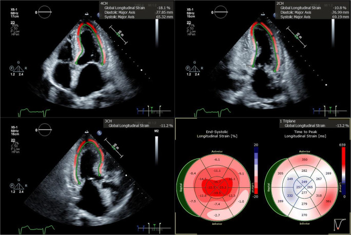 Amyloidosis with Cardiac Involvement: Identification, Characterization, and Management.