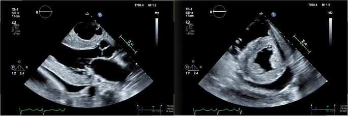 Amyloidosis with Cardiac Involvement: Identification, Characterization, and Management.