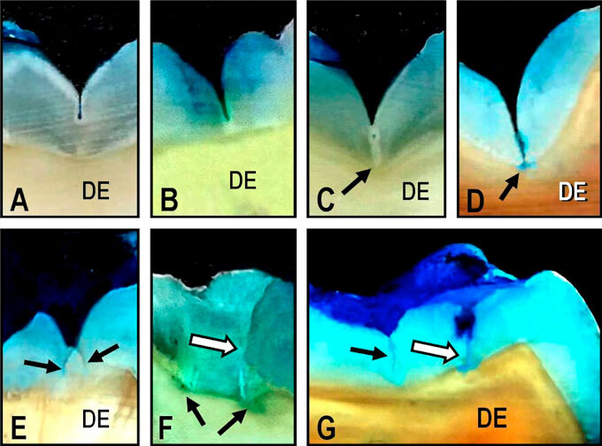 Pit and fissure depth in the enamel of mandibular third molars: An open gate for microleakage?