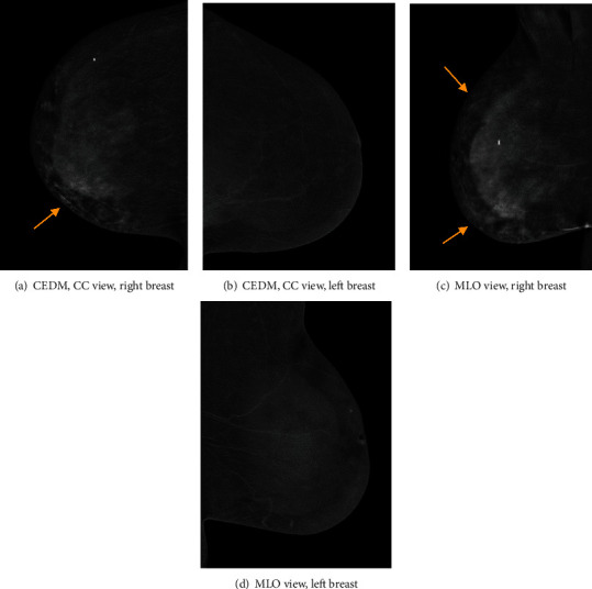 Contrast-Enhanced Mammography in the Diagnosis of Breast Angiosarcoma.