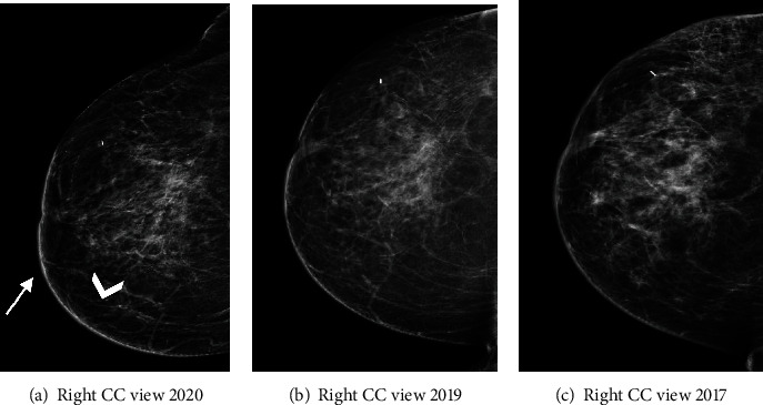 Contrast-Enhanced Mammography in the Diagnosis of Breast Angiosarcoma.