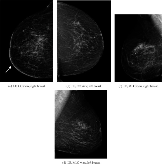 Contrast-Enhanced Mammography in the Diagnosis of Breast Angiosarcoma.