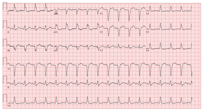 Tumor lysis Syndrome in a Patient with Metastatic Breast Cancer Treated with Alpelisib.