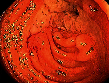 Late-Onset Posttransplant Lymphoproliferative Disorder Results in Jejunal Stricture Managed with Endoscopic Dilation.