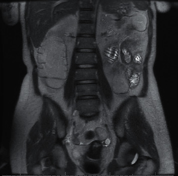 Late-Onset Posttransplant Lymphoproliferative Disorder Results in Jejunal Stricture Managed with Endoscopic Dilation.