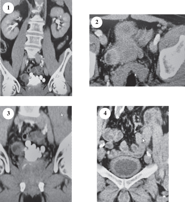 Challenging Cases in Urothelial Cancer: Case 21.