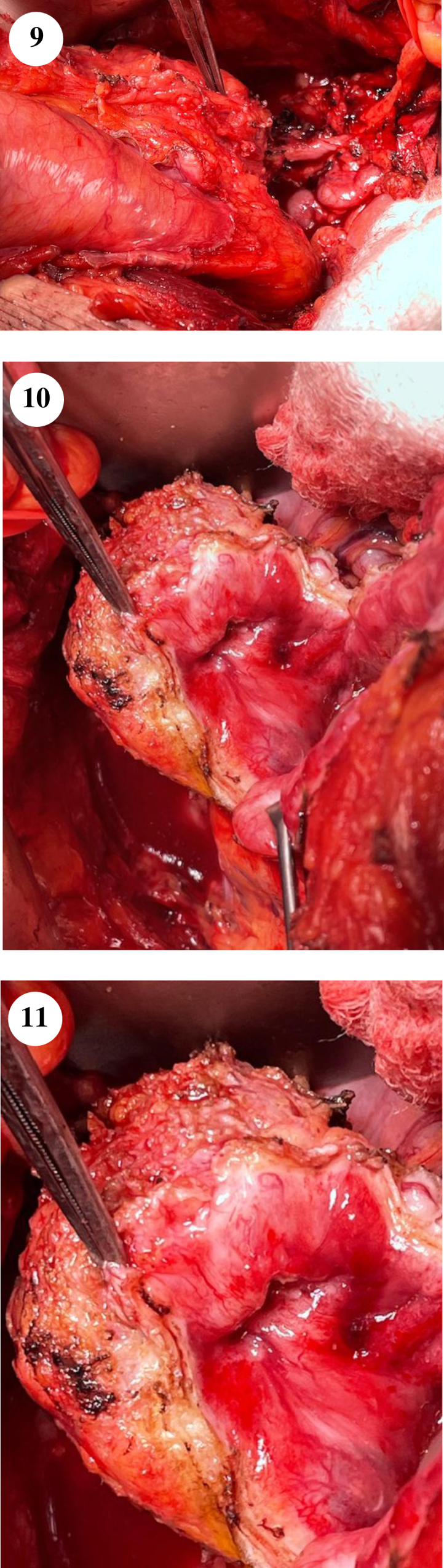 Challenging Cases in Urothelial Cancer: Case 21.
