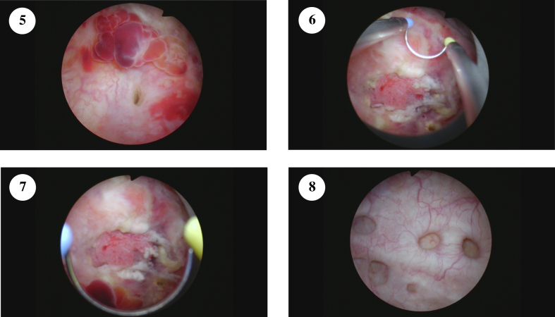 Challenging Cases in Urothelial Cancer: Case 21.
