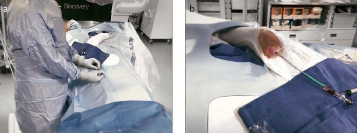 Evaluation of repeat distal transradial access in the anatomic snuffbox.