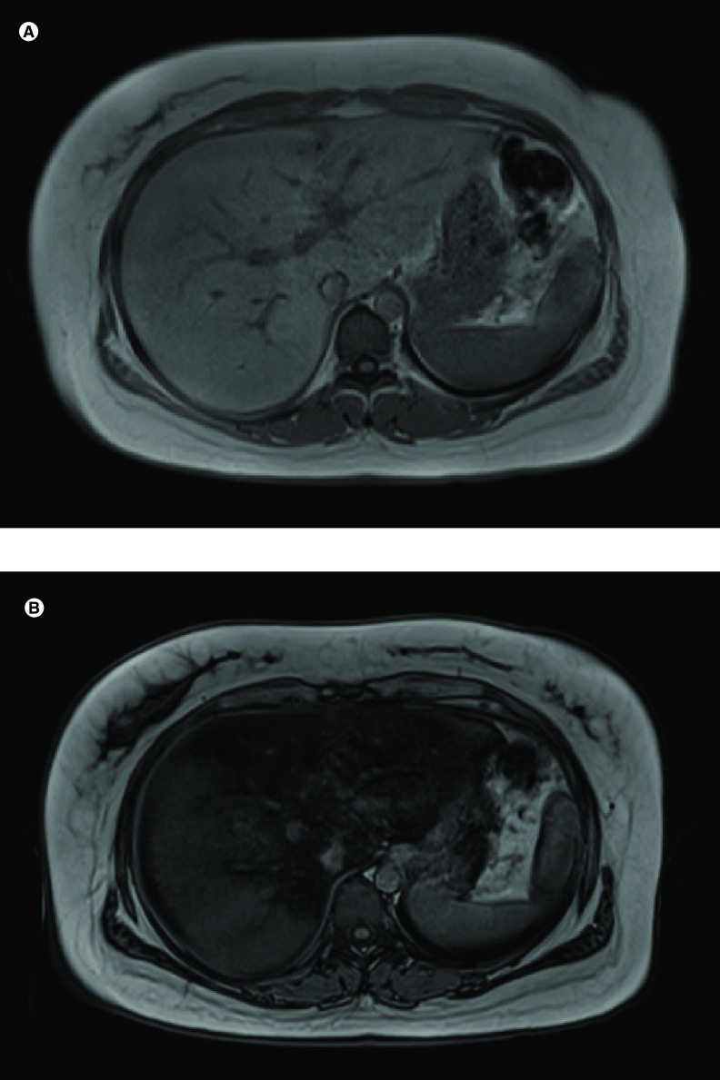 Imaging of chemotherapy-induced liver toxicity: an illustrated overview.