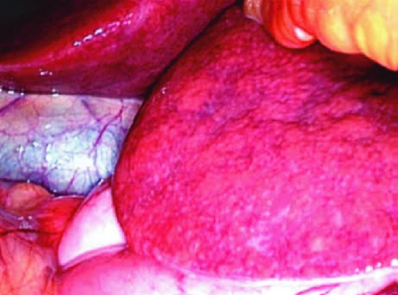 Imaging of chemotherapy-induced liver toxicity: an illustrated overview.