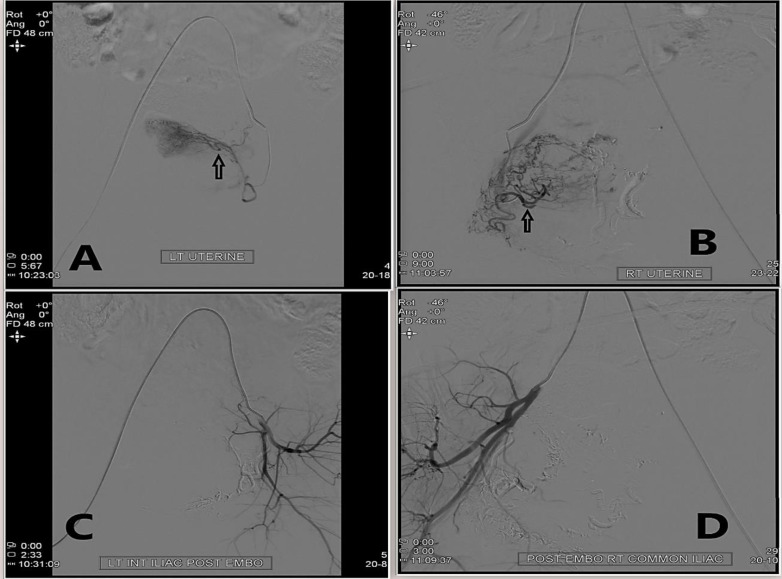 Arteriovenous Malformation Complicating Cesarean Scar Pregnancy: A Rare Case of Vaginal Bleeding Managed Successfully by Uterine Artery Embolization.