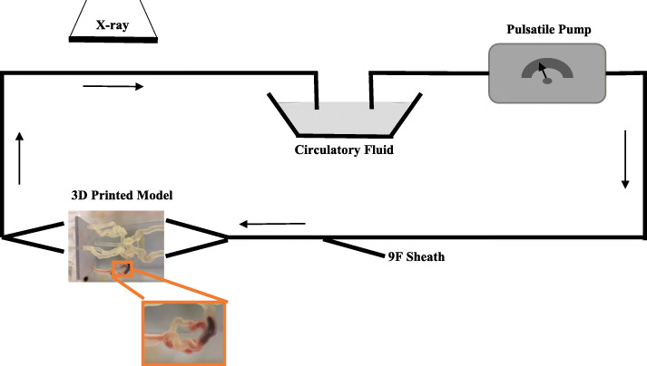 Use of patient specific 3D printed neurovascular phantoms to simulate mechanical thrombectomy.