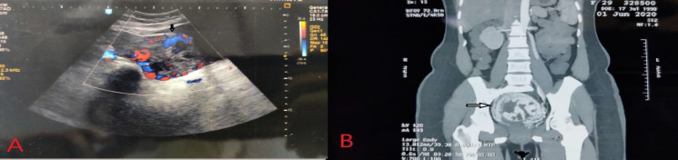 Arteriovenous Malformation Complicating Cesarean Scar Pregnancy: A Rare Case of Vaginal Bleeding Managed Successfully by Uterine Artery Embolization.