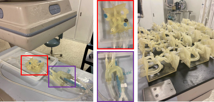 Use of patient specific 3D printed neurovascular phantoms to simulate mechanical thrombectomy.