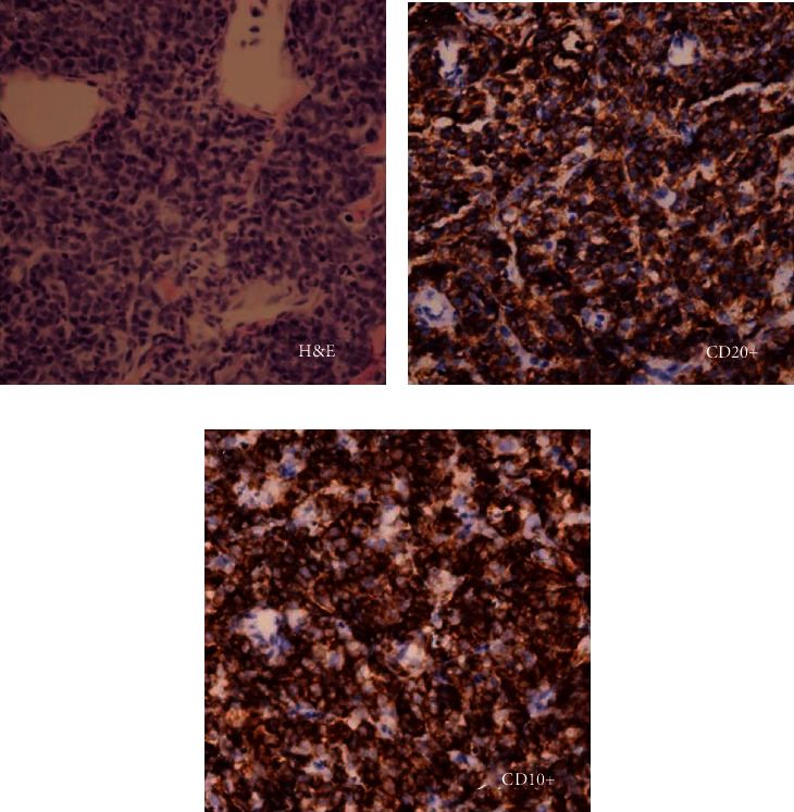 Sporadic Burkitt Lymphoma Presenting with Middle Cranial Fossa Masses with Sphenoid Bony Invasion and Acute Pancreatitis in a Child.