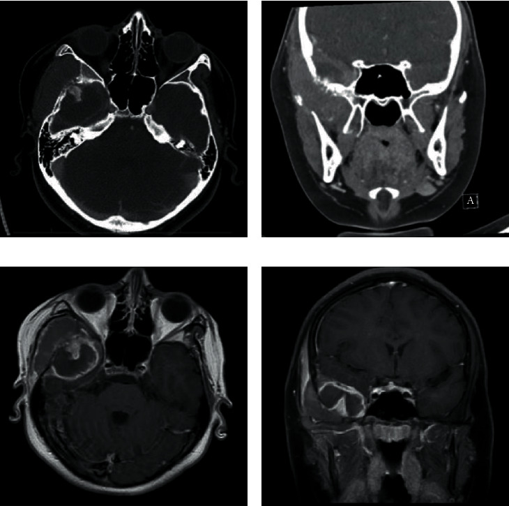 Sporadic Burkitt Lymphoma Presenting with Middle Cranial Fossa Masses with Sphenoid Bony Invasion and Acute Pancreatitis in a Child.