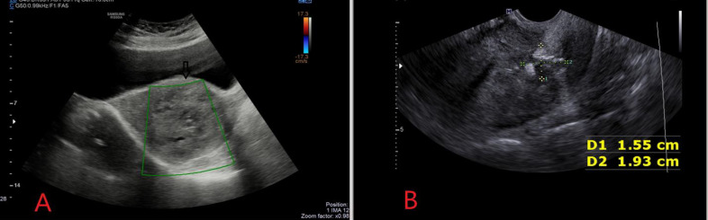 Arteriovenous Malformation Complicating Cesarean Scar Pregnancy: A Rare Case of Vaginal Bleeding Managed Successfully by Uterine Artery Embolization.