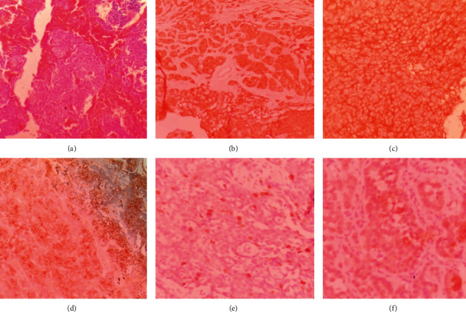 Neuroblastoma Soft Tissue Metastasis in a 10-Month-Old Infant with a Right Thigh Mass.