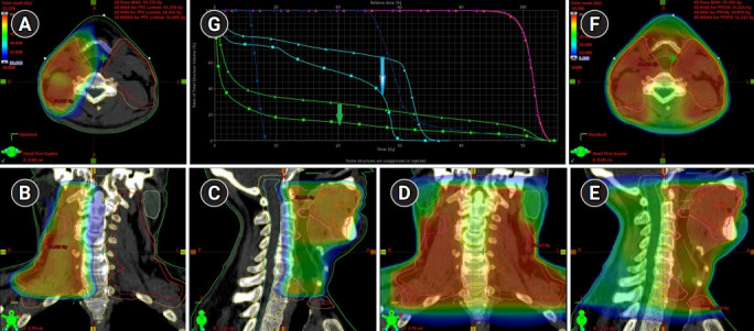 Single photon emission computed tomography-computed tomography visualization of sentinel lymph nodes for lymph flow guided nodal irradiation in oral tongue cancer.